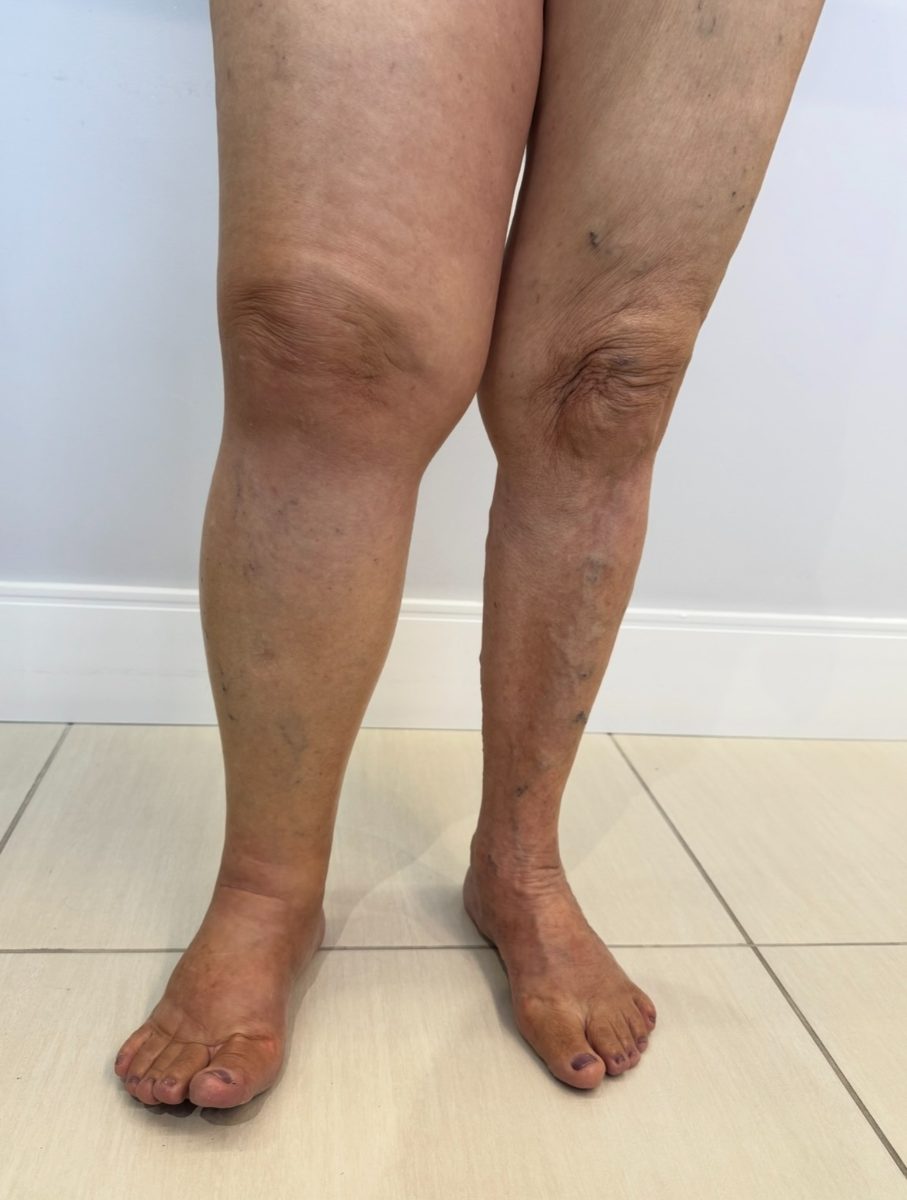 Tratamento de linfedema