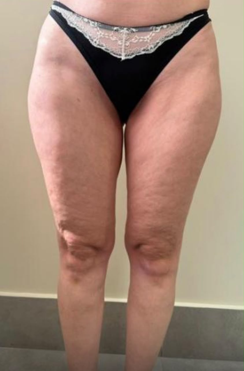 Tratamento de lipedema